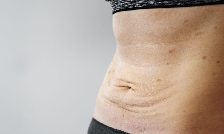 Abdominoplastie