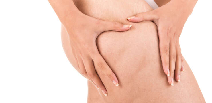 Liposuction